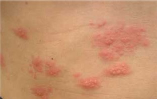 帯状疱疹の症例画像