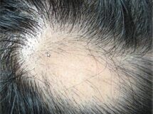 脱毛症の症例画像