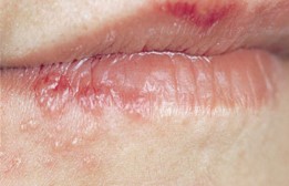 口唇ヘルペスの症例画像