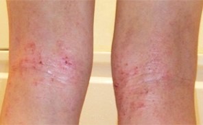 アトピー性皮膚炎の症例画像